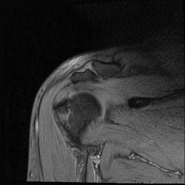 File:Avulsion fracture - greater tuberosity of humerus (Radiopaedia 71216-81515 Coronal T2 8).jpg