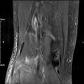 Avulsion fracture of the fibular head (Radiopaedia 74804-85808 Coronal PD fat sat 30).jpg