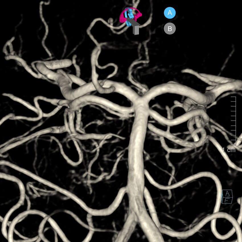 Basilar artery perforator aneurysm (Radiopaedia 82455-97734 3D view left VA 116).jpg