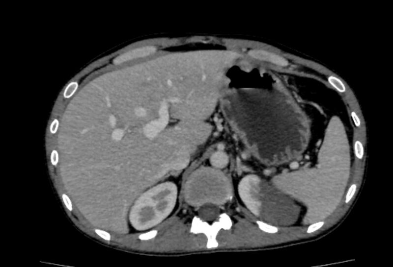 File:Behçet's disease- abdominal vasculitis (Radiopaedia 55955-62570 A 15).jpg