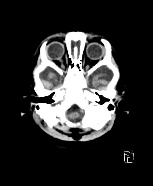 File:Benign enlargement of subarachnoid spaces in infancy (BESS) (Radiopaedia 87459-103795 Axial non-contrast 76).jpg