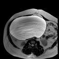 Benign seromucinous cystadenoma of the ovary (Radiopaedia 71065-81300 B 25).jpg