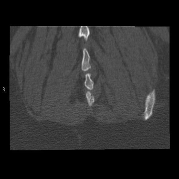 File:Bertolotti syndrome (Radiopaedia 24864-25128 Coronal bone window 48).jpg