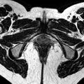 Bicornuate uterus (Radiopaedia 11104-11492 Axial T2 1).jpg