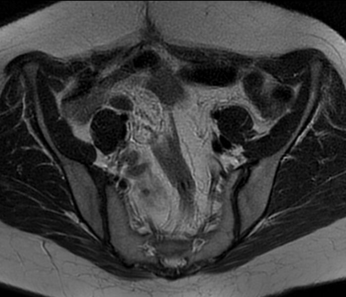 File:Bicornuate uterus (Radiopaedia 76407-88114 Axial T2 5).jpg