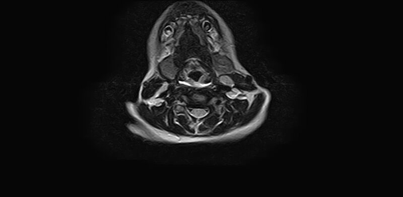 File:Bilateral Sprengel deformity with Klippel-Feil syndrome (Radiopaedia 66395-75650 Axial T2 12).jpg
