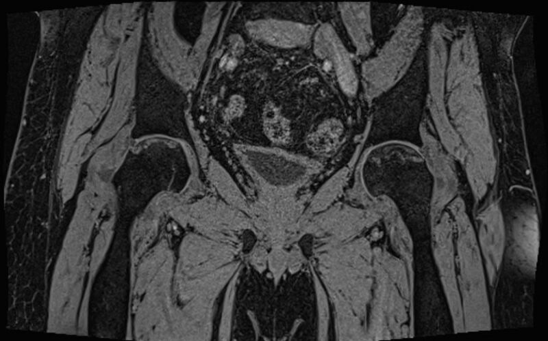 File:Bilateral avascular necrosis of femoral head (Radiopaedia 77116-89078 Coronal T2 we 41).jpg