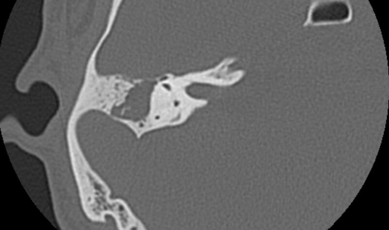 File:Bilateral cholesteatoma (Radiopaedia 54898-61172 Axial bone window 31).jpg