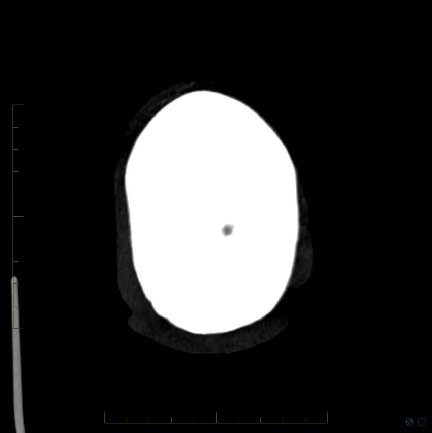 Bilateral chronic common carotid occlusion (Radiopaedia 50849-56362 D 2).jpg