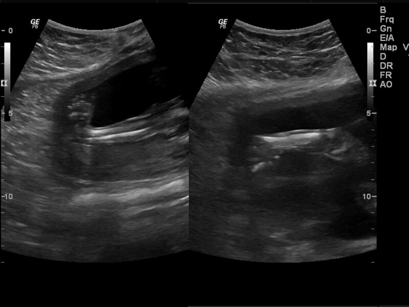 File:Bilateral congenital talipes equino-varus deformity in fetus (Radiopaedia 23337-23412 E 1).jpg
