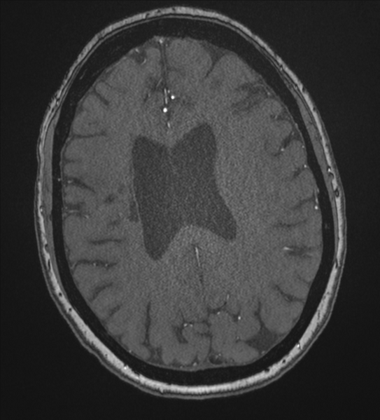 File:Bilateral fetal posterior communicating arteries (Radiopaedia 41286-44102 Axial MRA 147).png