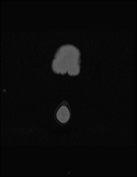 File:Bilateral frontal mucoceles (Radiopaedia 82352-96454 Coronal 6).jpg