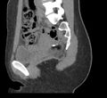 Bilateral mature cystic ovarian teratoma (Radiopaedia 88821-105592 D 22).jpg