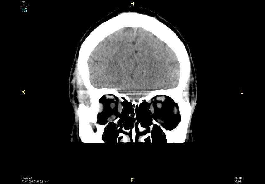 Bilateral medial medullary infarction (Radiopaedia 42220-45295 Coronal non-contrast 15).jpg