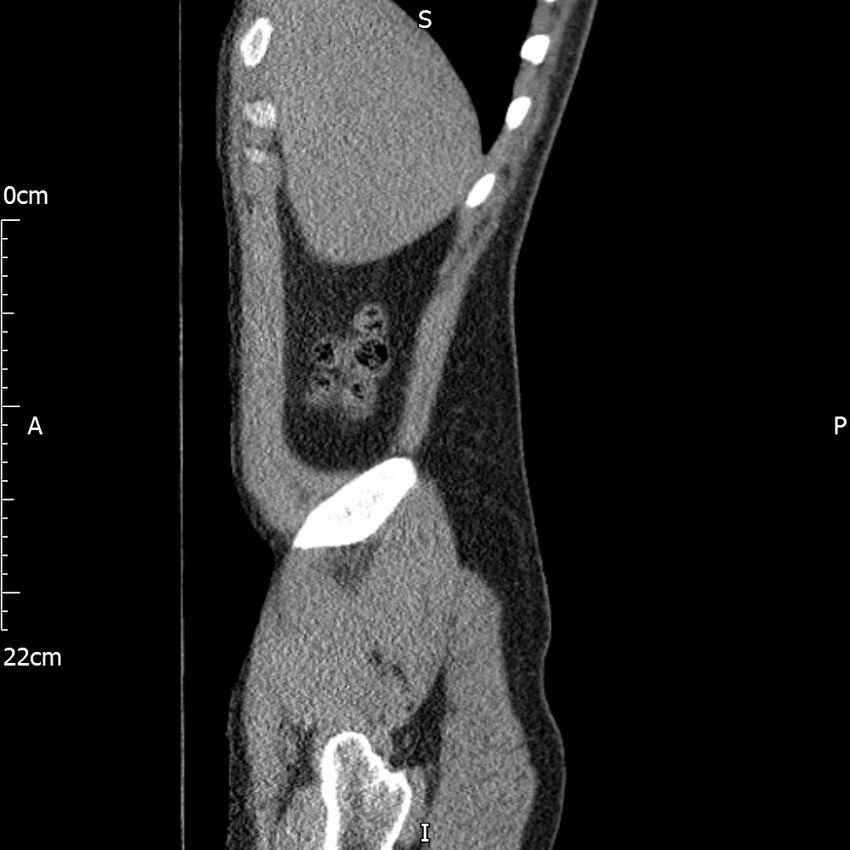 Bilateral medullary nephrocalcinosis with ureteric calculi (Radiopaedia 71269-81569 C 98).jpg