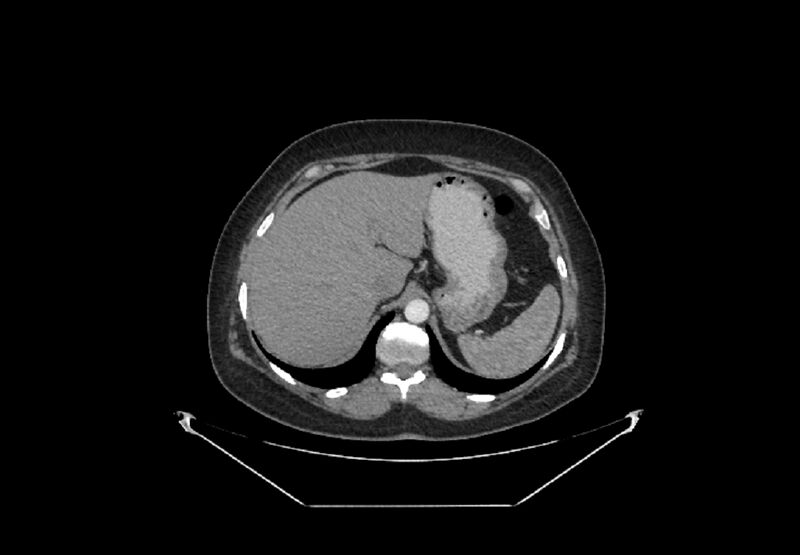 File:Bilateral urolithiasis with incidentally detected splenic artery aneurysm and left inferior vena cava (Radiopaedia 44467-48127 A 2).jpg