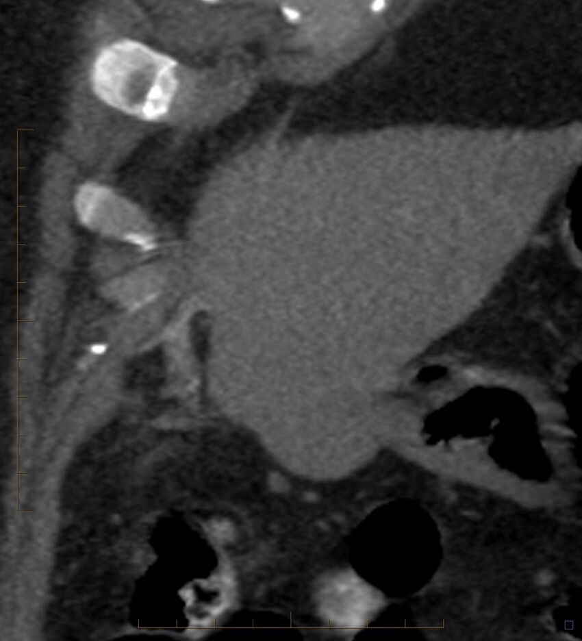 Bile leak from accessory duct(s) of Luschka post cholecystectomy (Radiopaedia 40736-43389 B 12).jpg