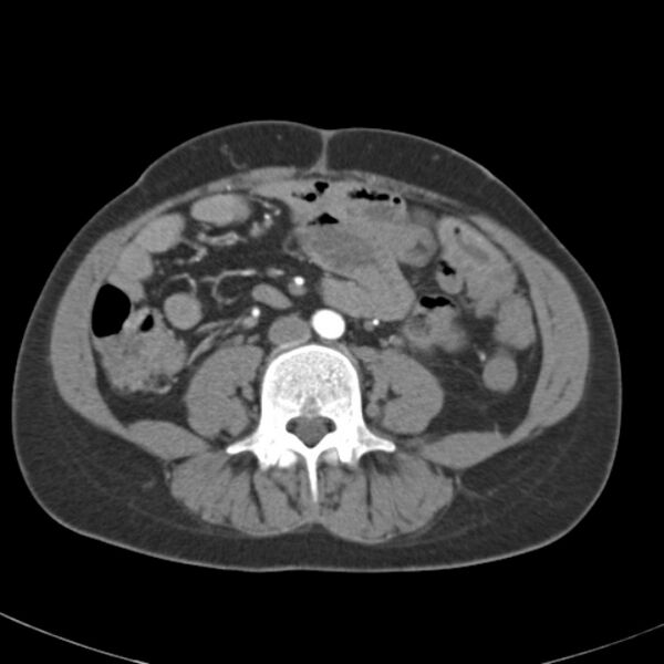 File:Biliary necrosis - liver transplant (Radiopaedia 21876-21845 A 39).jpg