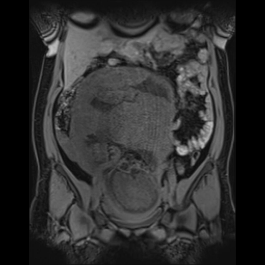 Bilobed placenta accreta (Radiopaedia 69648-79591 Coronal T1 vibe 83).jpg