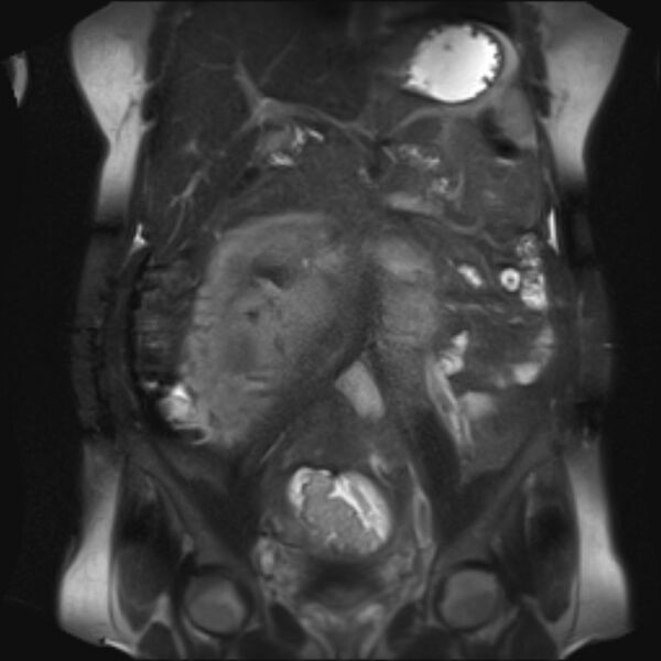 File:Bilobed placenta accreta (Radiopaedia 69648-79591 Coronal T2 fat sat 22).jpg