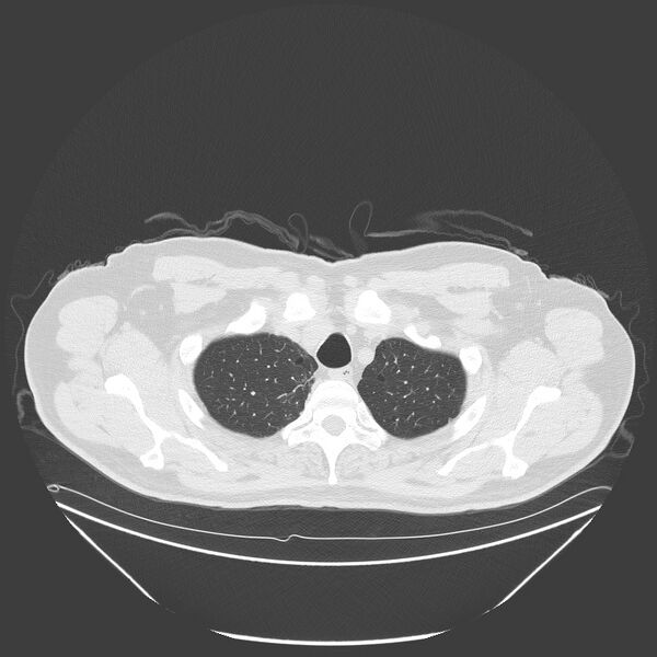 File:Birt-Hogg-Dubé syndrome (Radiopaedia 52578-58491 Axial lung window 8).jpg