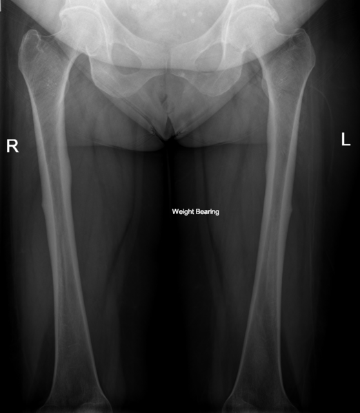 File:Bisphosphonate-induced femoral stress fractures (Radiopaedia 50844-56354 Frontal 1).PNG