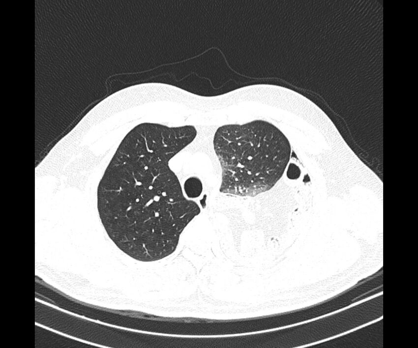 Bochdalek hernia - adult presentation (Radiopaedia 74897-85925 Axial lung window 11).jpg