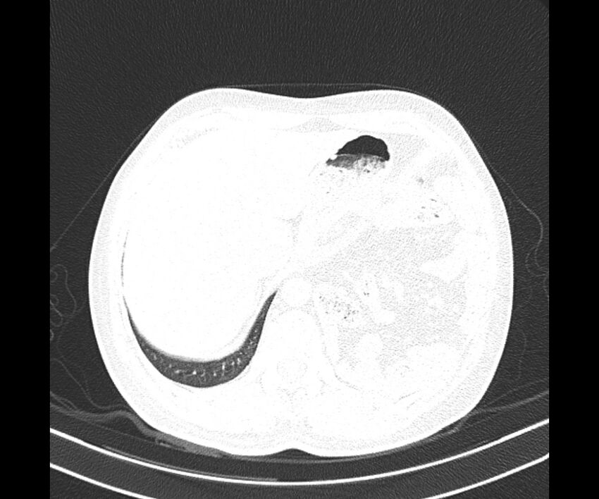 Bochdalek hernia - adult presentation (Radiopaedia 74897-85925 Axial lung window 41).jpg