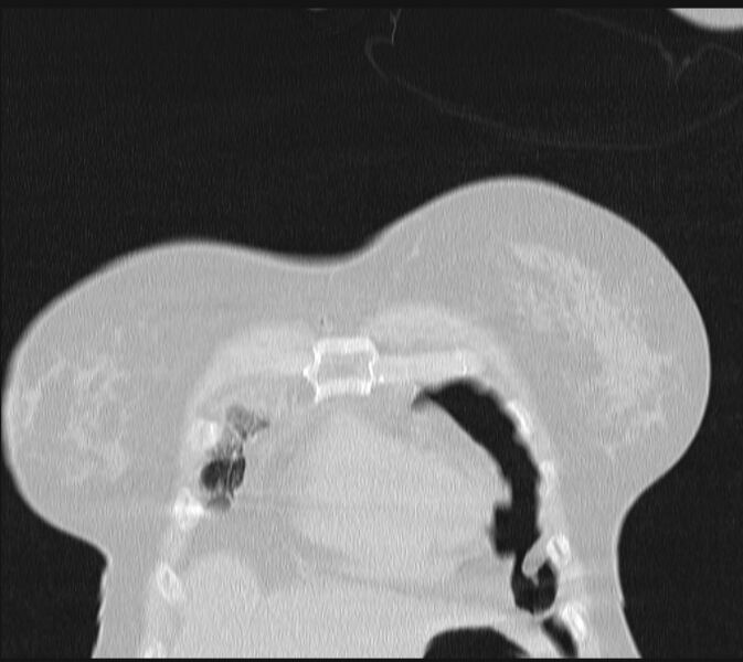 File:Boerhaave syndrome (Radiopaedia 45644-49799 Coronal lung window 10).jpg