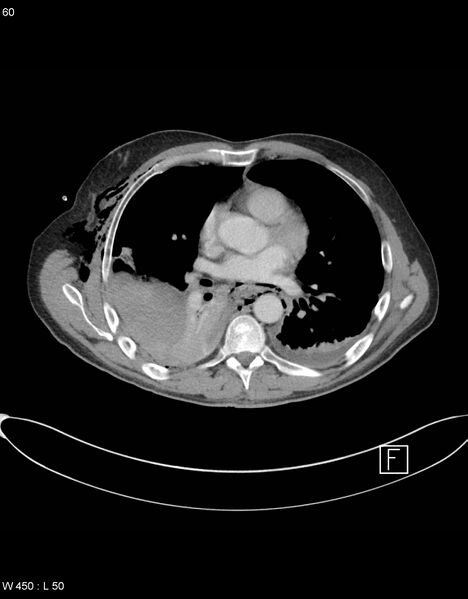 File:Boerhaave syndrome with tension pneumothorax (Radiopaedia 56794-63605 A 29).jpg