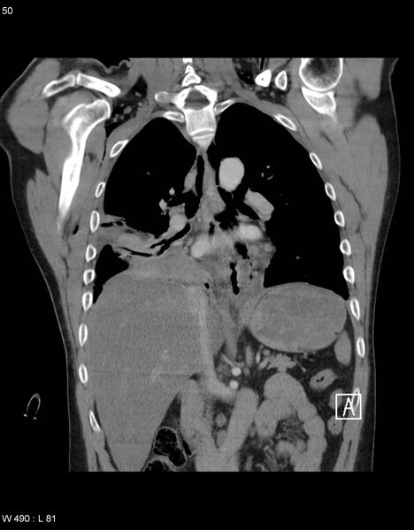 File:Boerhaave syndrome with tension pneumothorax (Radiopaedia 56794-63605 B 20).jpg