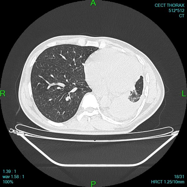 File:Bone metastases from lung carcinoma (Radiopaedia 54703-60937 Axial lung window 18).jpg