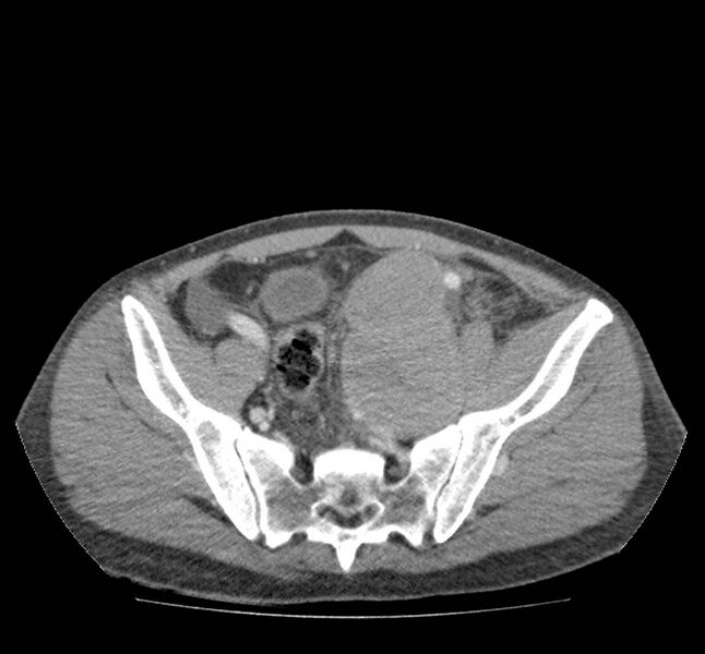 File:Bowel lymphoma complicated by bleeding after therapy (Radiopaedia 55601-62107 A 66).jpg