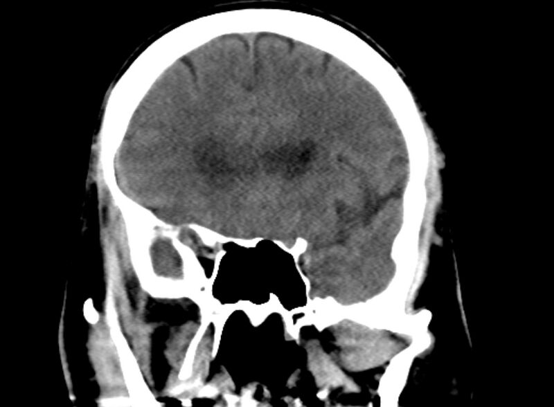 File:Brain abscess complicated by intraventricular rupture and ventriculitis (Radiopaedia 82434-96575 Coronal non-contrast 6).jpg
