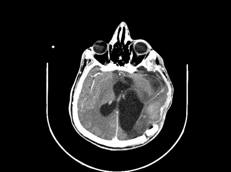 File:Brain injury by firearm projectile (Radiopaedia 82068-96088 B 128).jpg