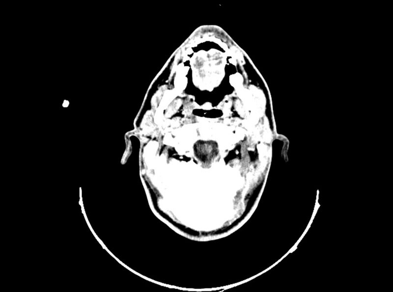 File:Brain injury by firearm projectile (Radiopaedia 82068-96088 B 56).jpg