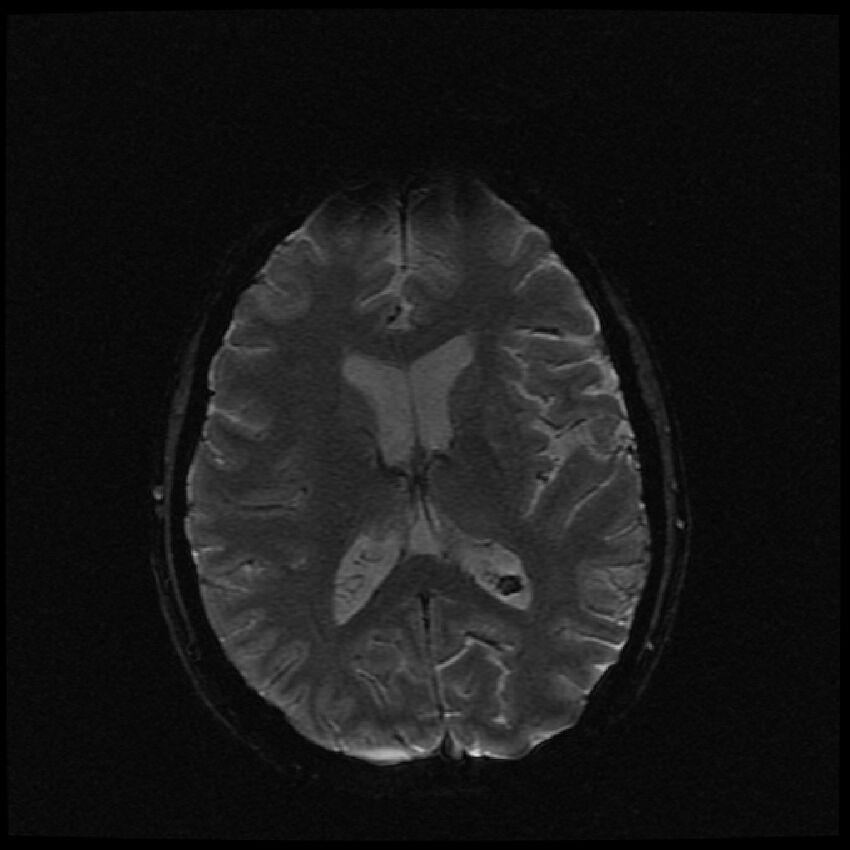 Brain metastases (renal cell carcinoma) (Radiopaedia 42571-45704 Axial SWI 26).jpg