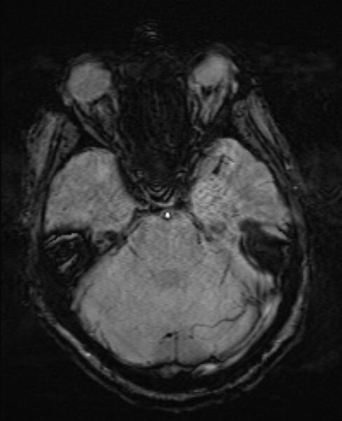 File:Brain metastases - lung cancer primary (Radiopaedia 75060-86115 Axial SWI 20).jpg