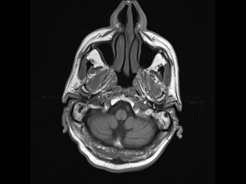 File:Brain metastases from renal cell carcinoma (Radiopaedia 42222-45297 Axial T1 4).jpg