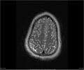 Brainstem glioma (Radiopaedia 21819-21775 Axial T2 33).jpg