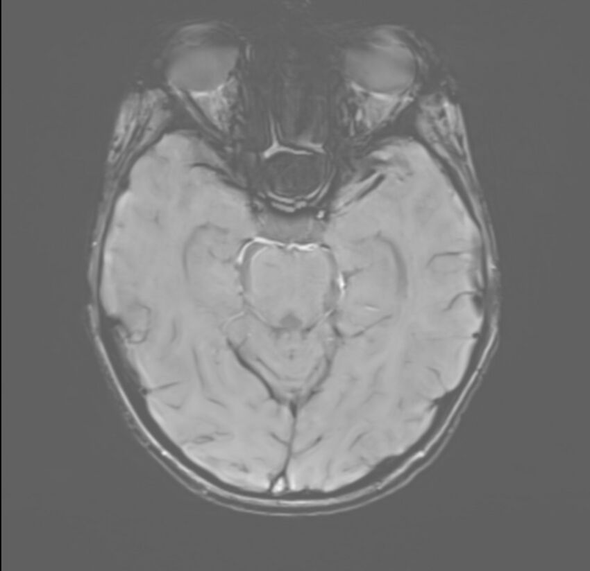 Brainstem glioma (Radiopaedia 70548-80674 Axial SWI 22).jpg
