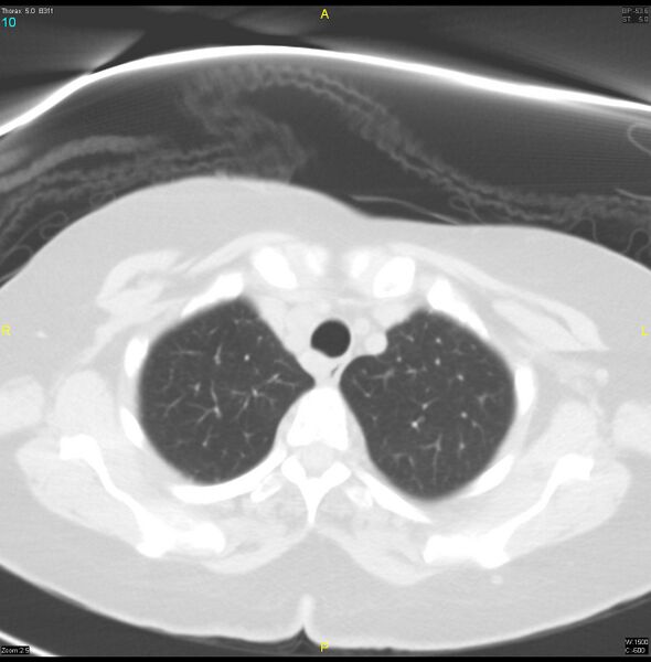 File:Breast primary with lung and bone metastases (Radiopaedia 40620-43228 Axial lung window 10).jpg