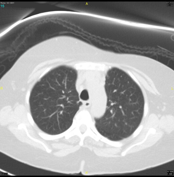 File:Breast primary with lung and bone metastases (Radiopaedia 40620-43228 Axial lung window 15).jpg