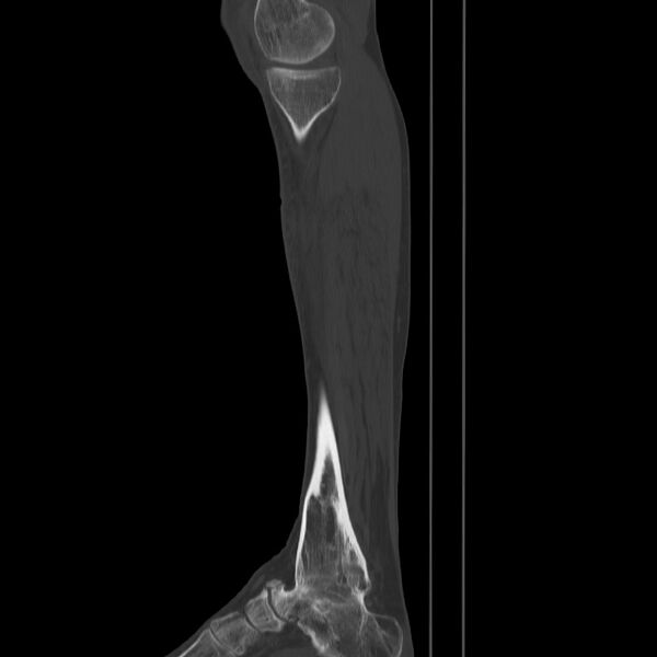 File:Brodie abscess - tibia (Radiopaedia 66028-75204 Sagittal bone window 13).jpg