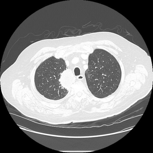 File:Bronchogenic adenocarcinoma and pulmonary embolism (Radiopaedia 9097-9806 Axial lung window 6).jpg