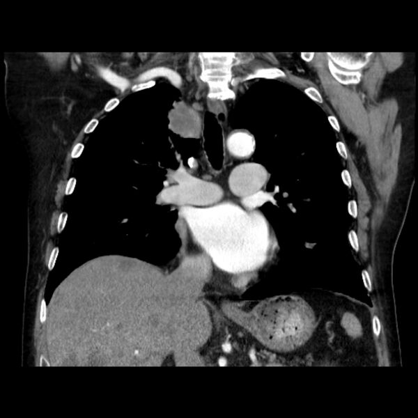File:Bronchogenic adenocarcinoma and pulmonary embolism (Radiopaedia 9097-9806 C 26).jpg