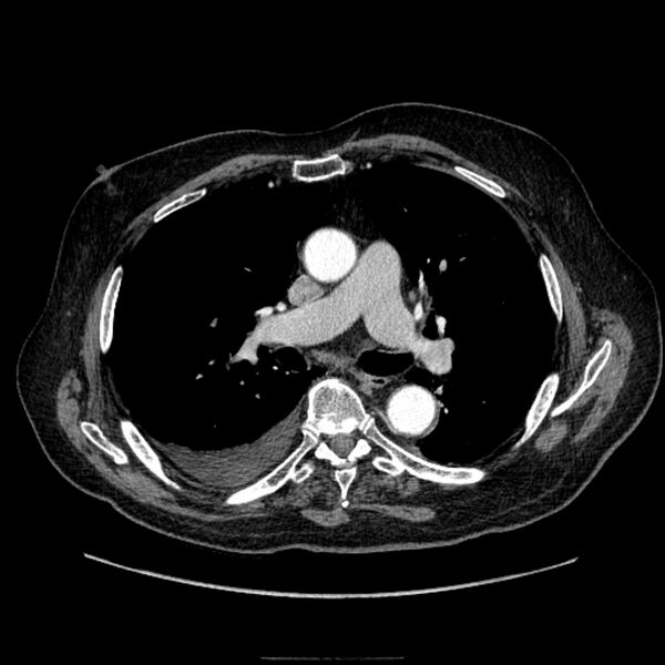 File:Bronchogenic adenocarcinoma and pulmonary embolism (Radiopaedia 9097-9806 D 30).jpg