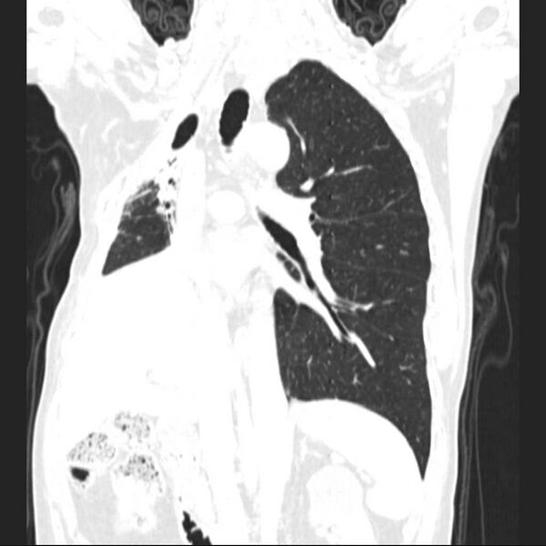 File:Bronchopleural fistula - postoperative complication (Radiopaedia 21020-20947 Coronal lung window 15).jpg