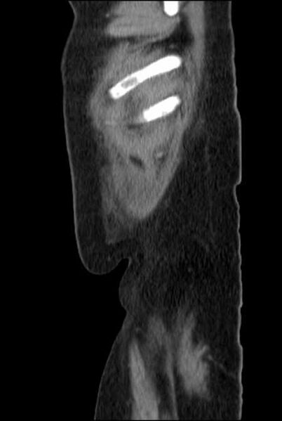 File:Brown tumors compressing the spinal cord (Radiopaedia 68442-77988 F 54).jpg