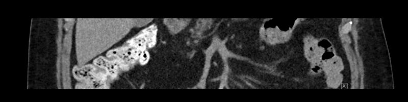 File:Buried bumper syndrome - gastrostomy tube (Radiopaedia 63843-72575 Coronal Inject 40).jpg